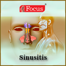 Sinusitis - An Overview