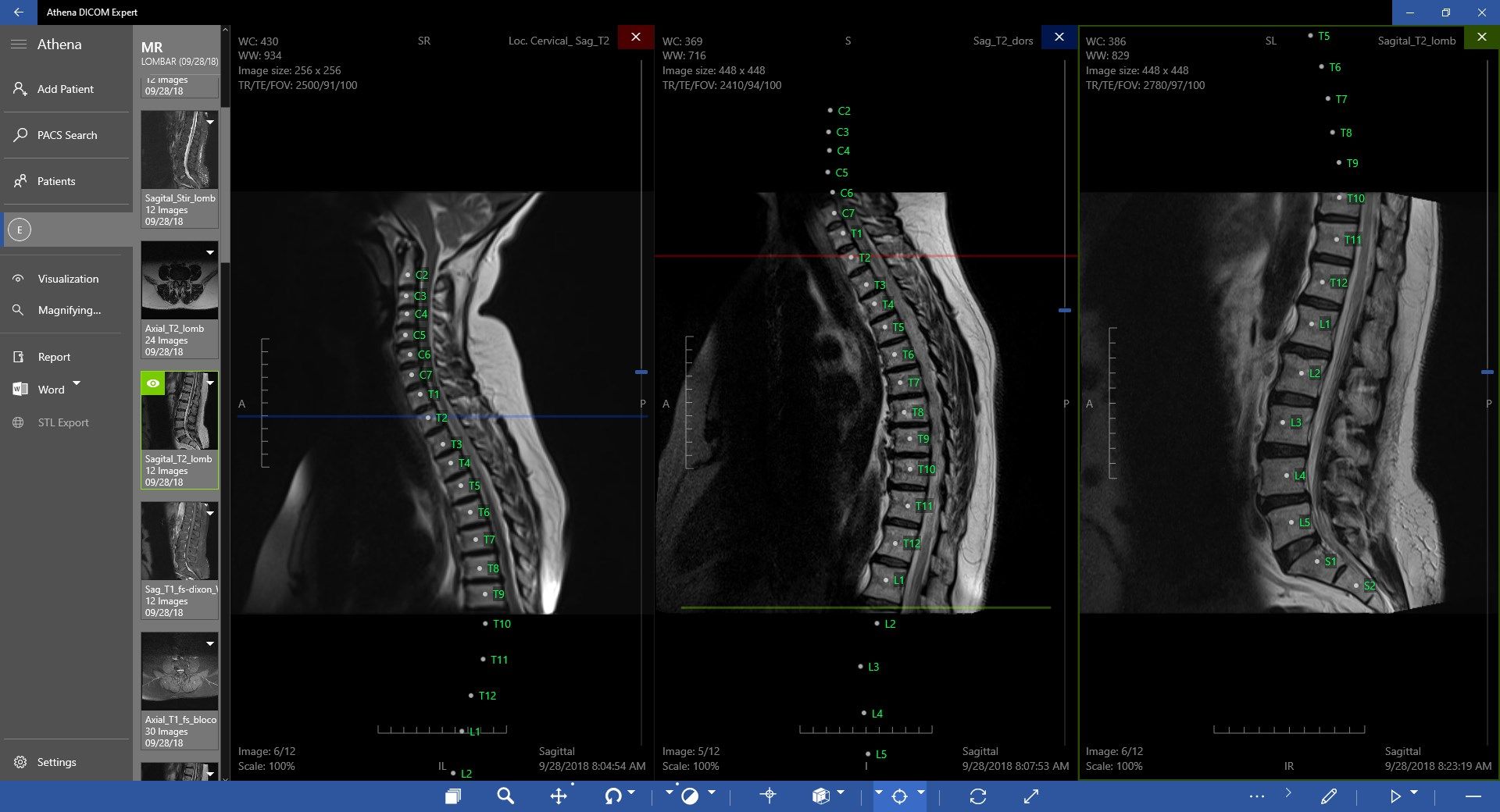 Spine Labeling Annotation