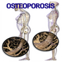 Osteoporosis Disease
