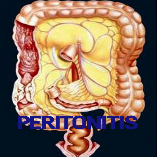 Peritonitis Disease