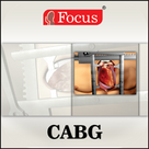 CABG - An Overview