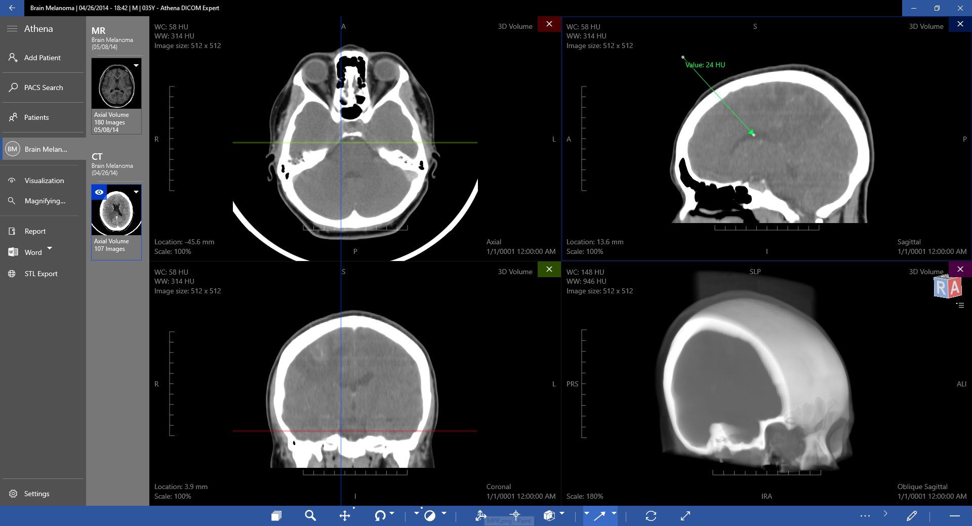 MPR + 3D of CT (MultiPlanar Reconstruction)