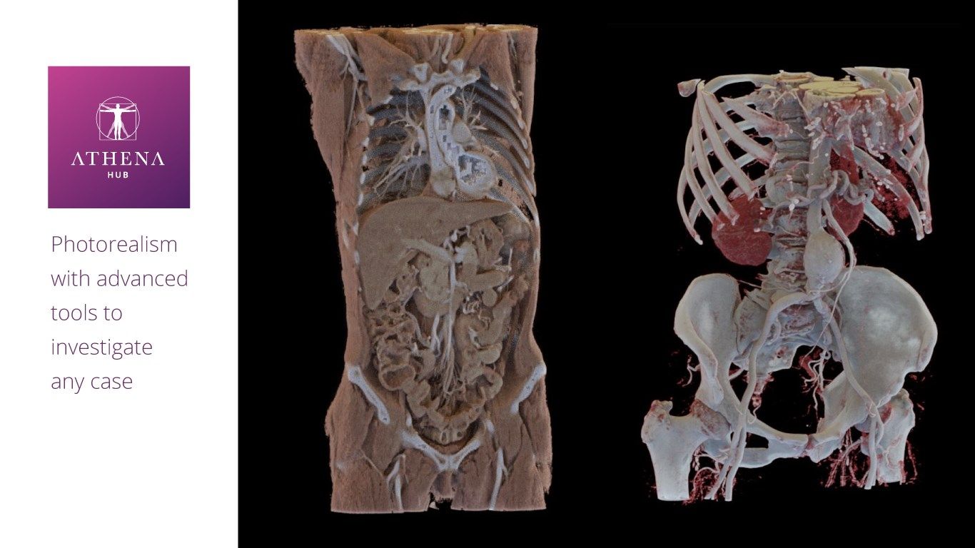 Real CT exams with 3D Photorealism and dissection tool make the detailed results impressive.