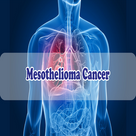 mesothelioma cancer best info mesothelioma cancer