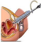About of Prostate Surgery