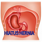 Hiatus Hernia Disease