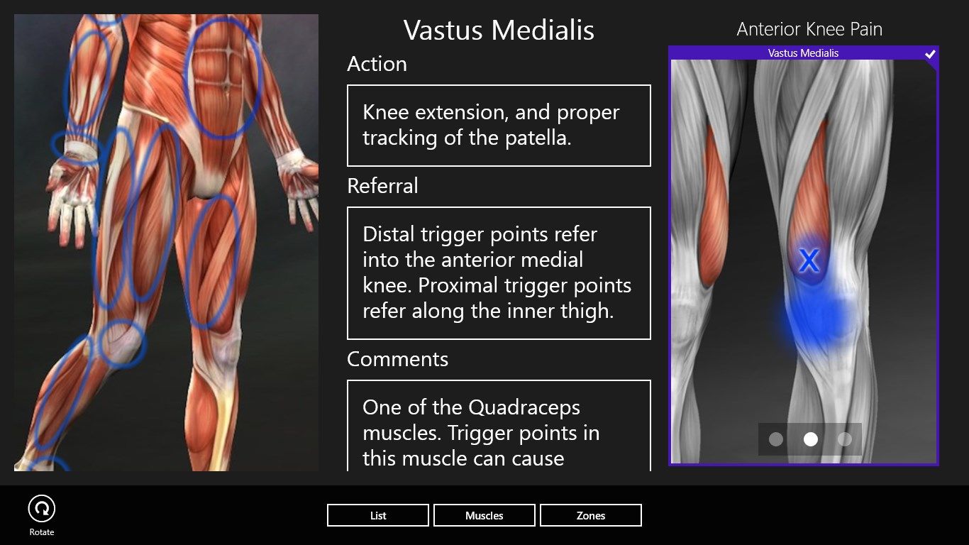 Anterior Knee pain from vastus lateralis muscle points