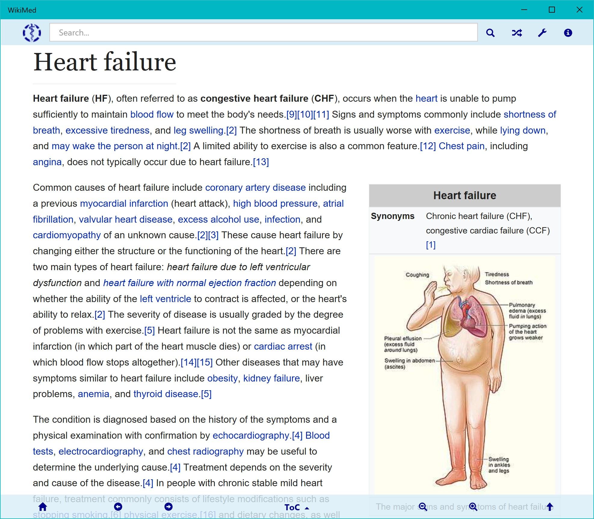 WikiMed Heart failure (light theme)