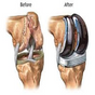 Surgeries of Knee Replacement