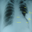 About of Pacemaker Surgery