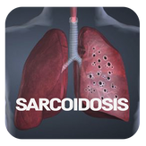 Sarcoidosis Disease