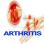 Arthritis Disease