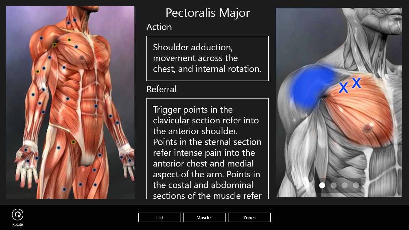 Anterior shoulder pain from pectoralis major trigger points